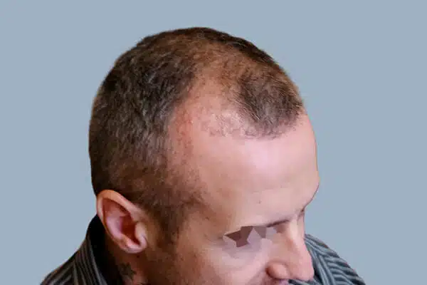 before hair transplant C