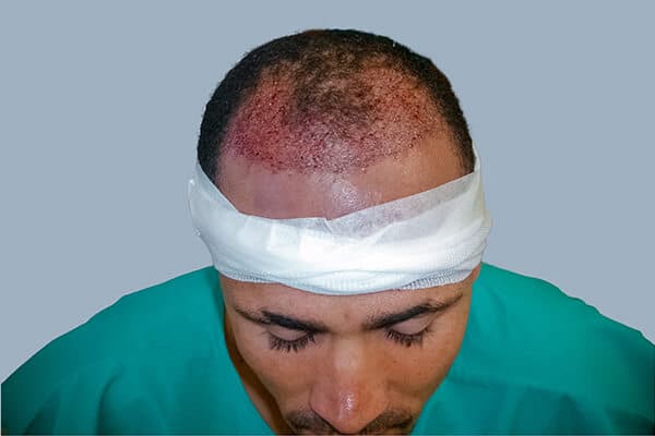 before hair transplant b