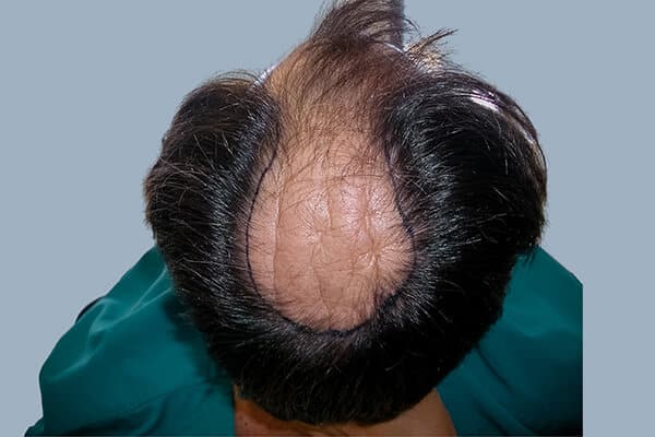 before hair transplant b
