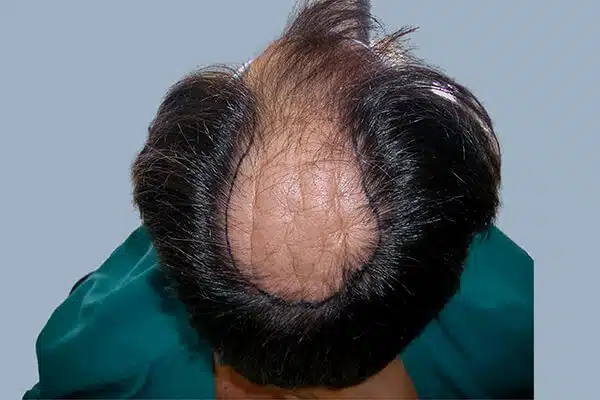 before hair transplant b