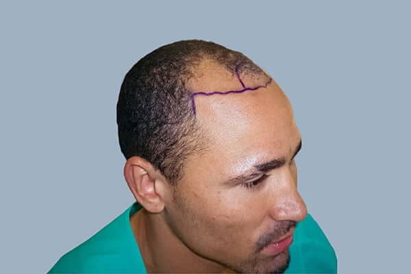 before hair transplant c