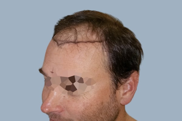before hair transplant surgery