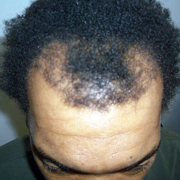 ethnic male hair transplant cape town