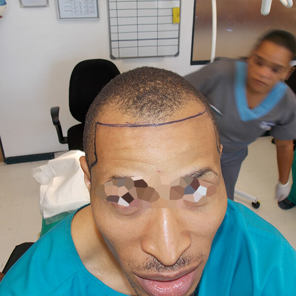 ethnic male hair transplant surgery