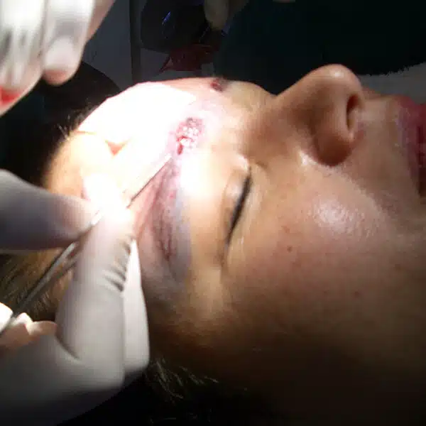 eyebrow hair transplant surgery female cape town
