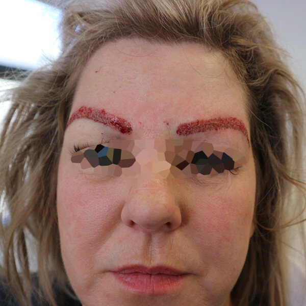 eyebrow hair transplant female