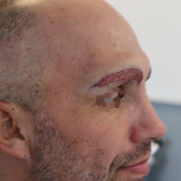 eyebrow hair transplant surgery male cape town