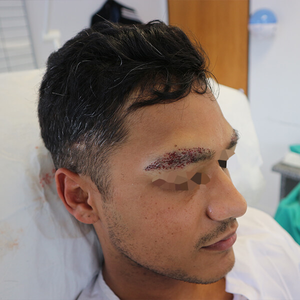 eyebrow hair transplant male