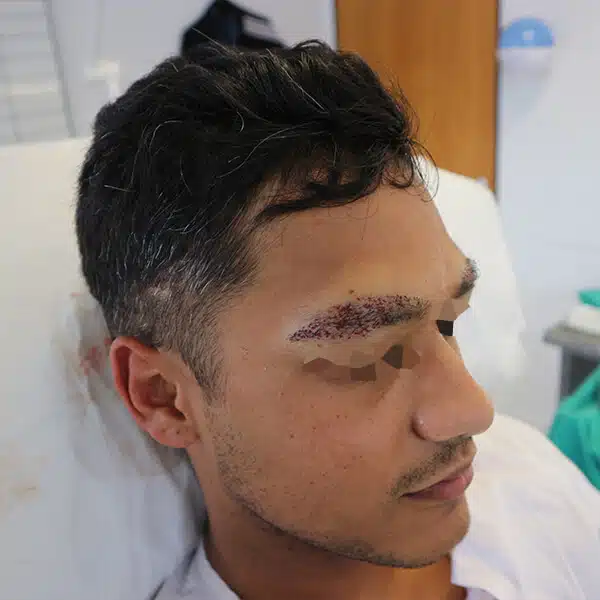eyebrow hair transplant male