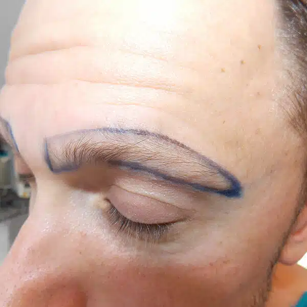 eyebrow hair transplant before