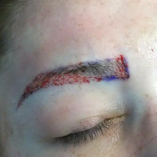 eyebrow hair transplant surgery