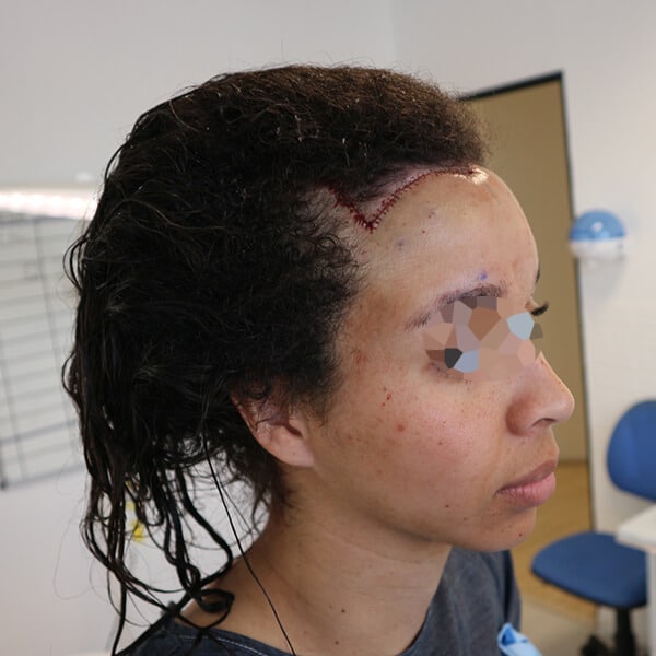 forehead lowering surgery