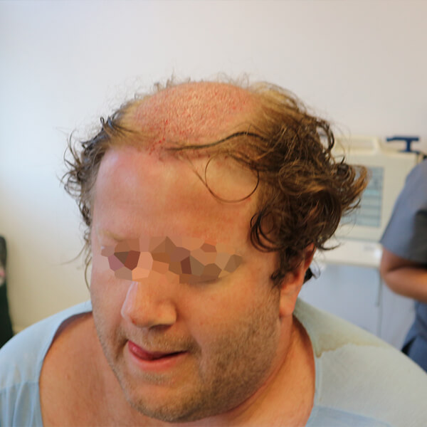 male hair transplant cape town