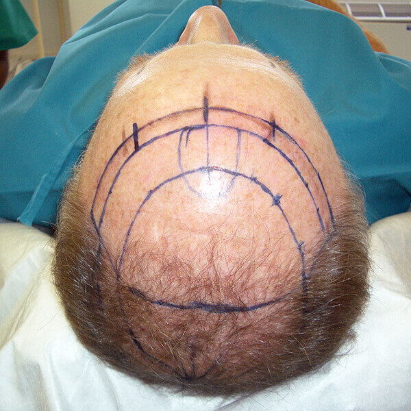 male hair transplant surgery