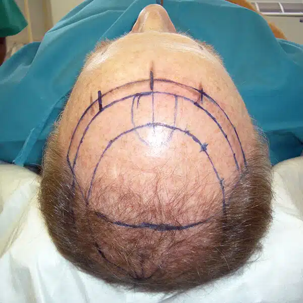 male hair transplant surgery