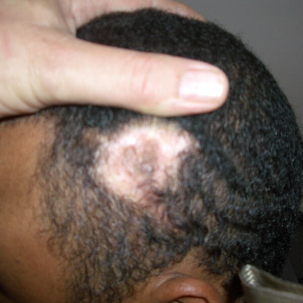 scar removal hair transplant