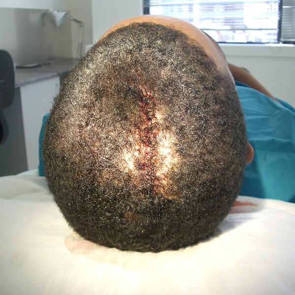 scar removal surgery cape town