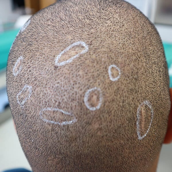 scar removal surgery, south africa