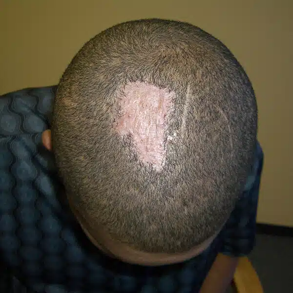 scar removal surgery south africa