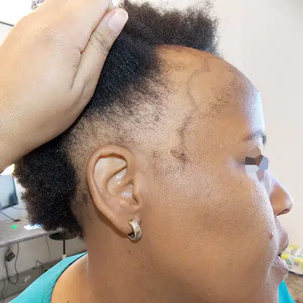 traction alopecia hair transplant surgery african