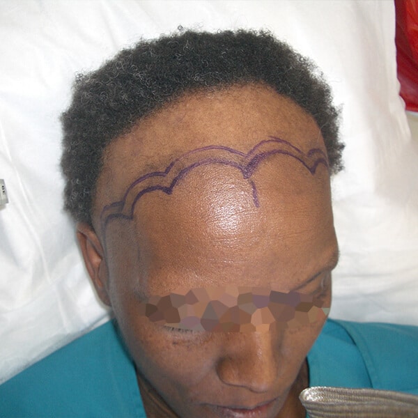 traction alopecia hair transplant surgery