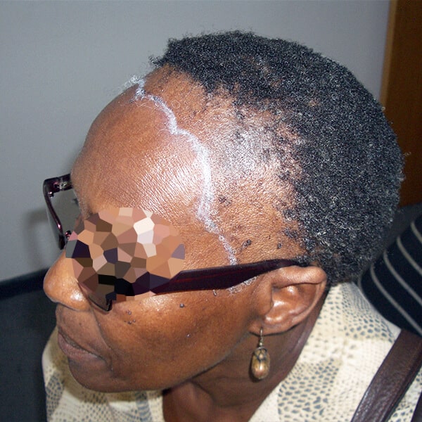traction alopecia surgery african