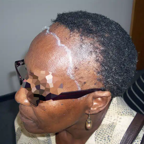 traction alopecia surgery african