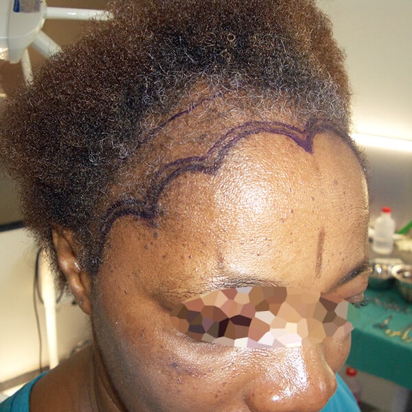 traction alopecia surgery