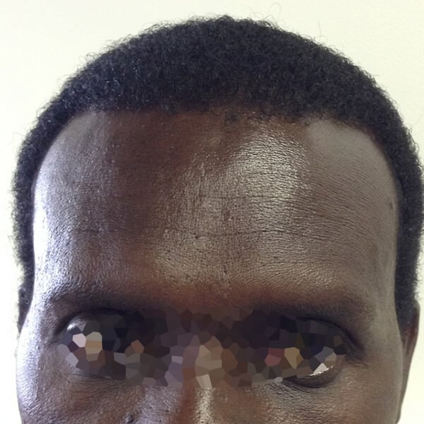 Afro-textured hair transplant Afro-textured hair transplant Cape Town South Africa