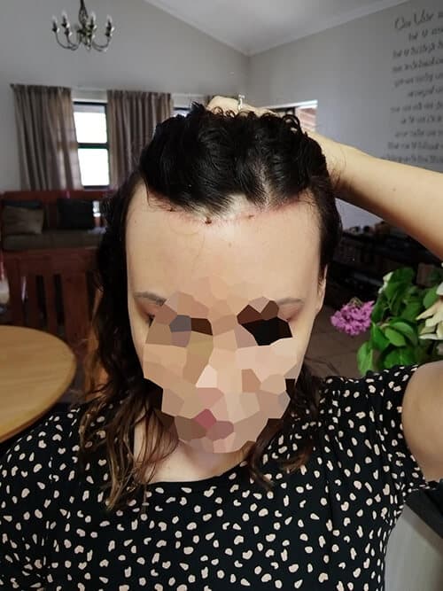 Forehead reduction surgery Cape Town after Forehead reduction surgery Cape Town after
