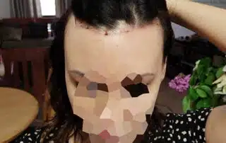 Forehead reduction surgery Cape Town after