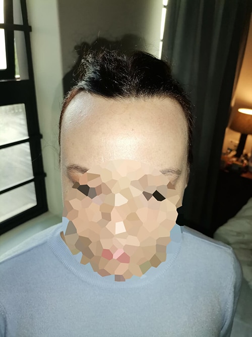 Forehead reduction surgery Cape Town before Forehead reduction surgery Cape Town before