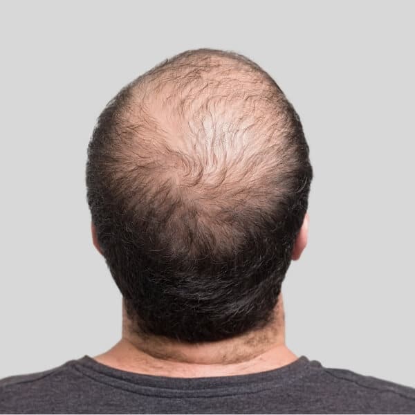 Are Hair Transplants Permanent when done after balding