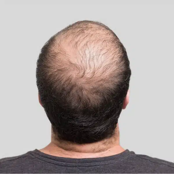 Are Hair Transplants Permanent when done after balding
