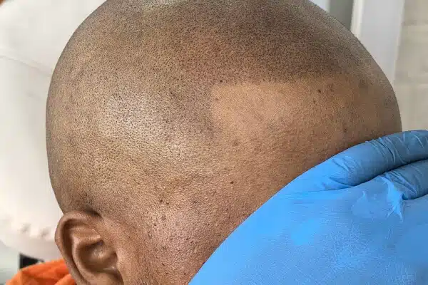 Pattern balding Scalp Micro Pigmentation after
