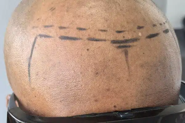 Pattern balding Scalp Micro Pigmentation before
