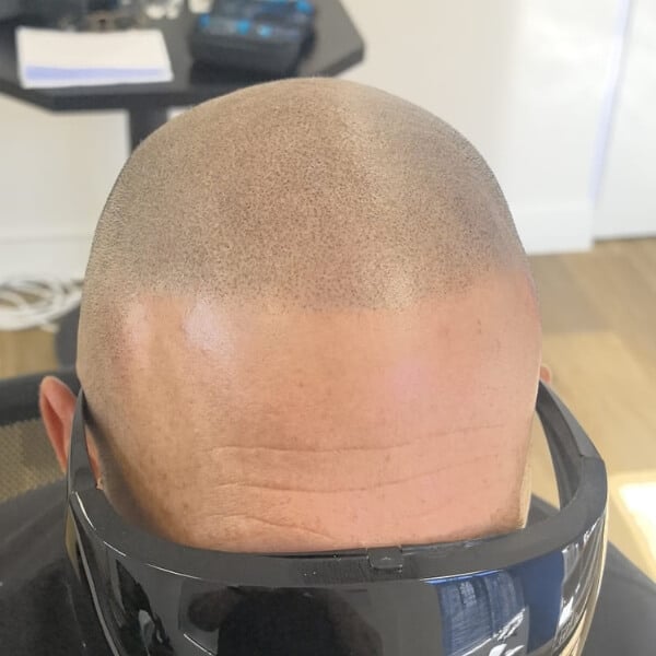Scalp Micropigmentation SMP Cape Town