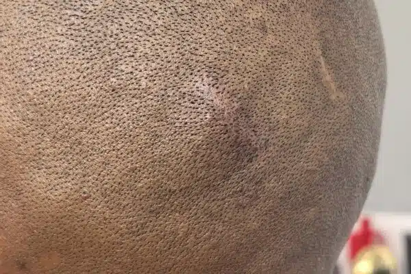 Scar repair Scalp Micro Pigmentation after