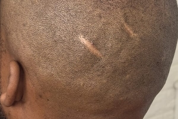 Scar repair Scalp Micro Pigmentation before