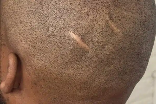 Scar repair Scalp Micro Pigmentation before