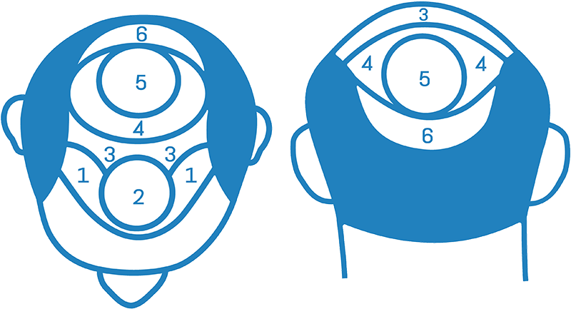 Hair Transplant Cape Town Cost Calculation