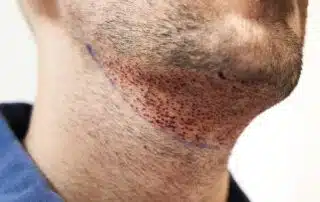 Beard implant Cape Town