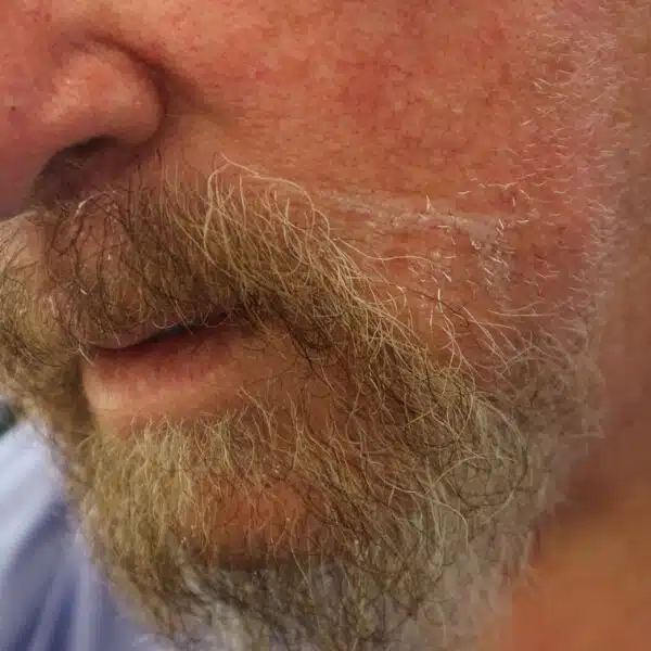 Beard transplant South Africa