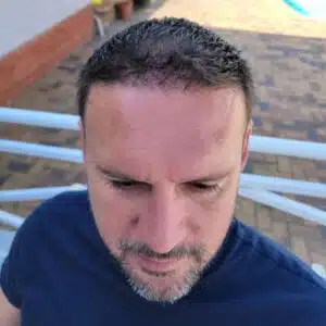 Are male hair transplants permanent Are male hair transplant in Cape Town permanent