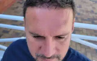 Are male hair transplant in Cape Town permanent
