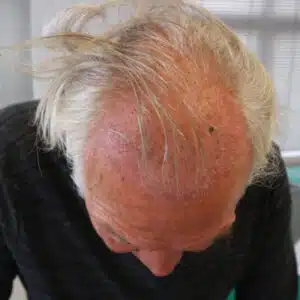 Good candidate for male hair transplant Good candidate for male hair transplant