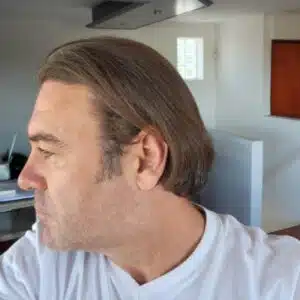 how long does a hair transplant last how long does a hair transplant last