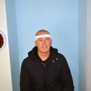 recovery after a male hair transplant surgery recovery after a male hair transplant surgery at Cape Town practice